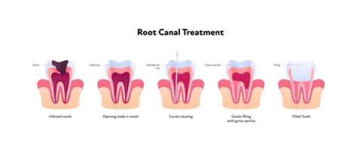 How do you know if a root canal is successful?