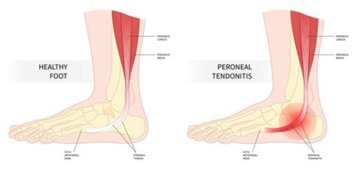 How do you know if it's tendonitis or bursitis?