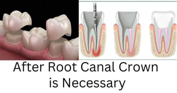 How do you know when you need a crown?