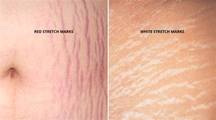 How does egg white get rid of stretch marks?