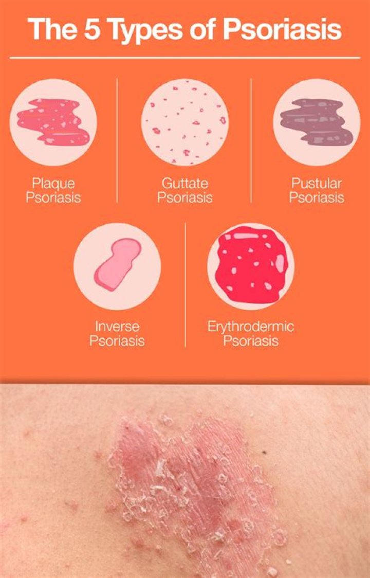 How does psoriasis affect your heart?