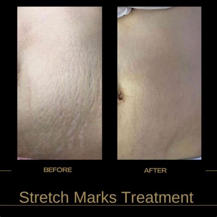 How does vitamin E get rid of stretch marks?