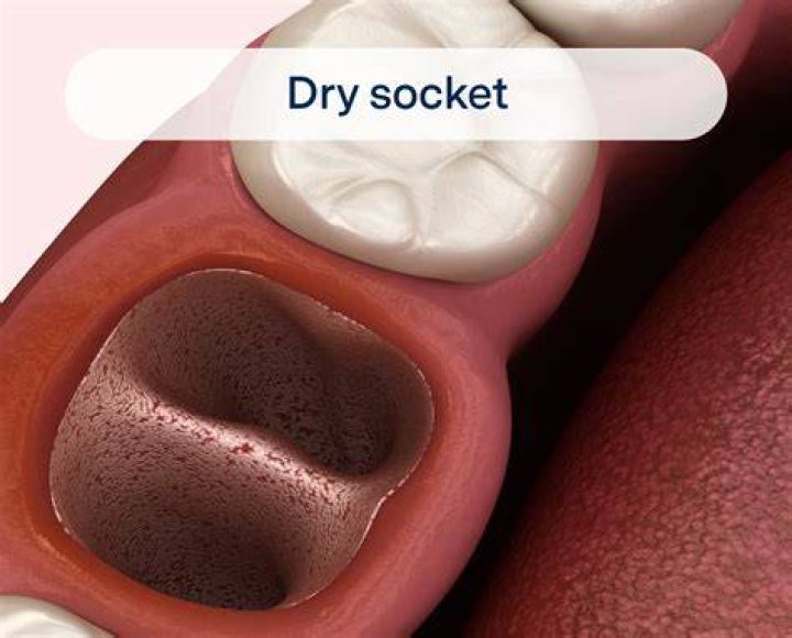 How easy is it to get dry socket?