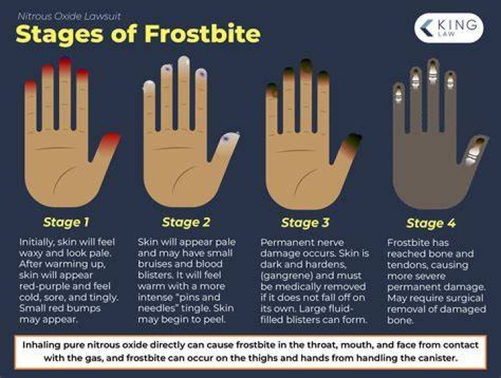 How fast can you get frostbite in?