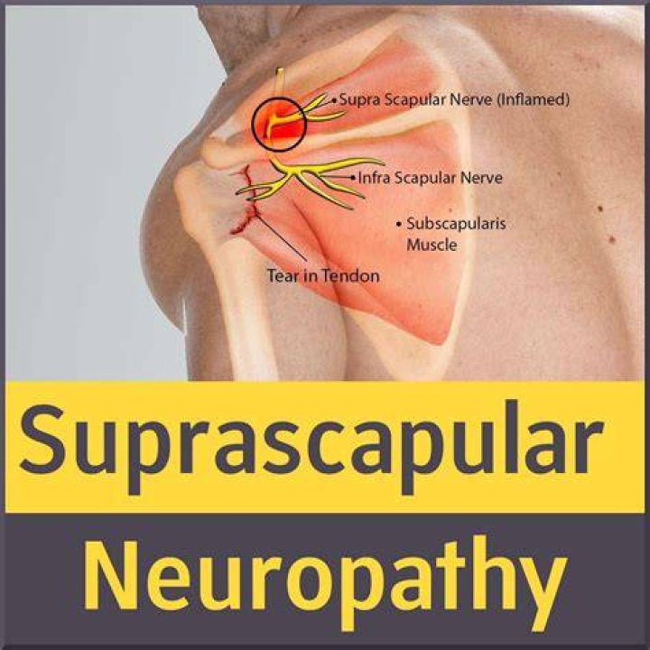 How is suprascapular nerve entrapment diagnosed?