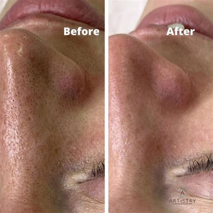 How long do pores stay open after sugaring?