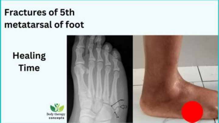 How long does 5th metatarsal fracture take to heal?