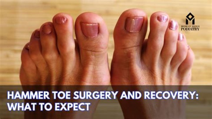 How long does hammer toe surgery last?