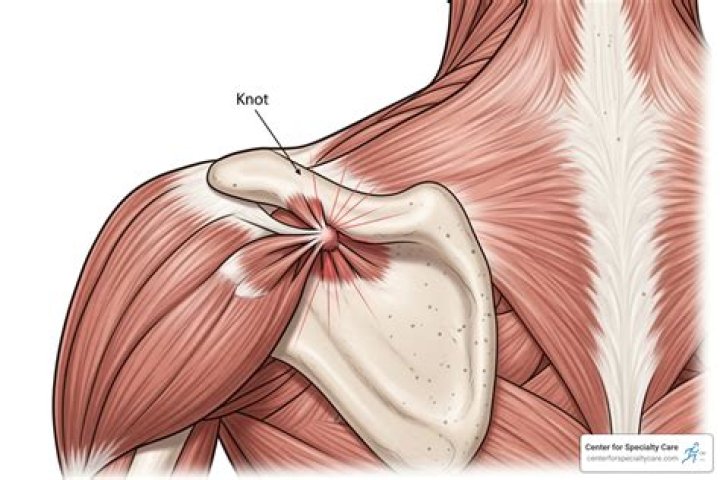 How long does it take to release a muscle knot?