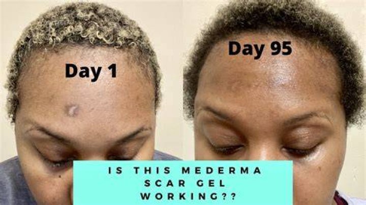 How long does Mederma take to remove scars?