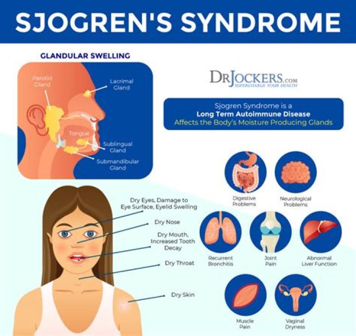 How long does Sjogren's syndrome last?