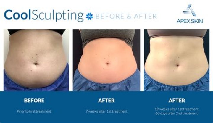 How many inches does CoolSculpting take off?