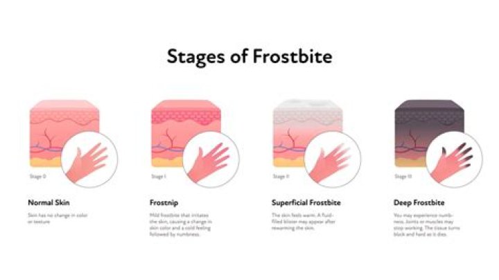 How serious can frostbite and frostnip become?