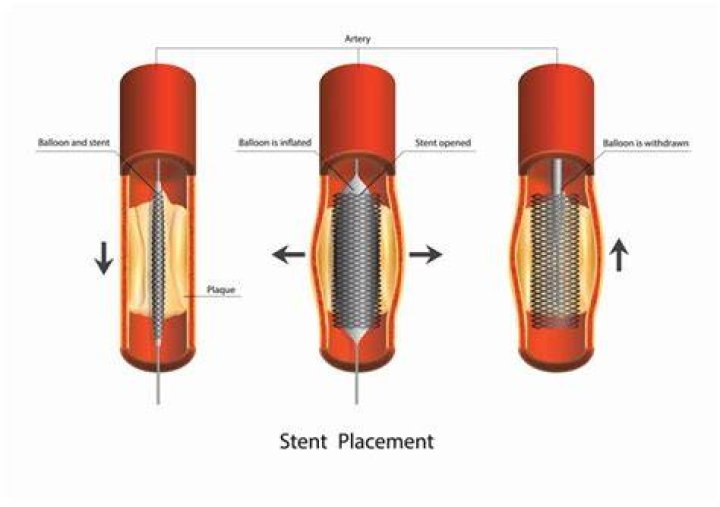 How serious is having a stent put in?