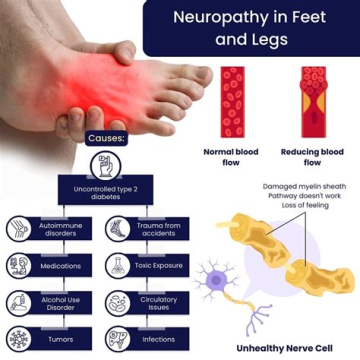 How serious is neuropathy in feet?