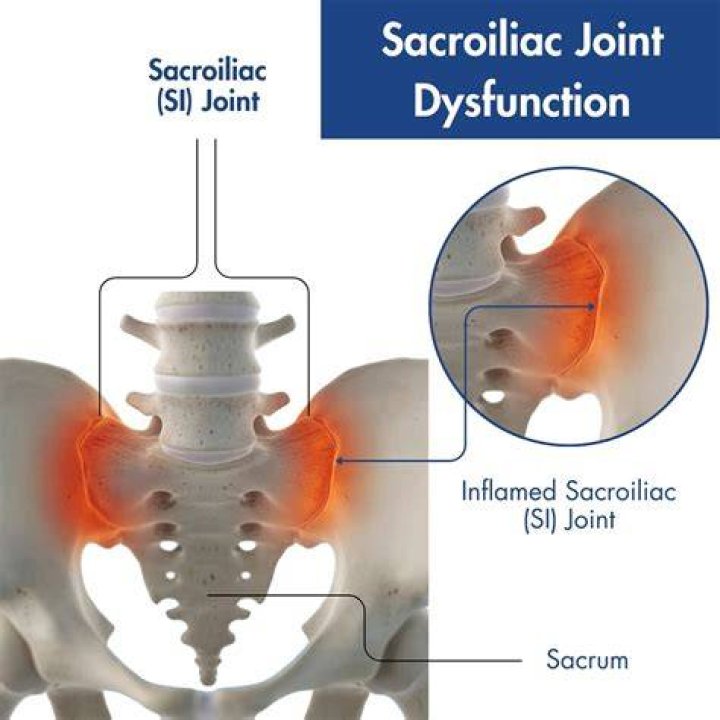 How serious is sacroiliitis?