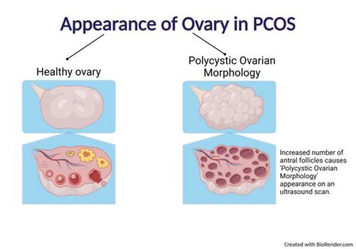 In which side of ovary is baby boy?