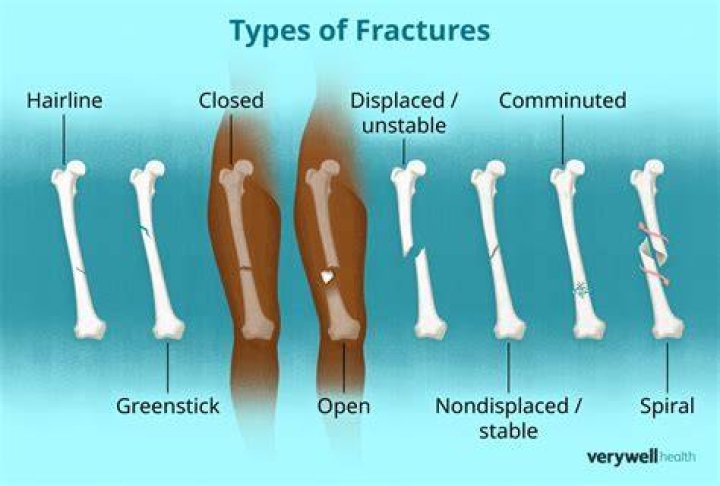 Is a fracture worse than a sprain?