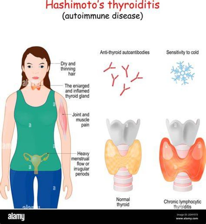 Is a thyroid problem an autoimmune disease?