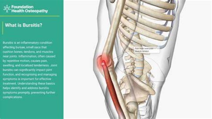 Is bursitis serious?