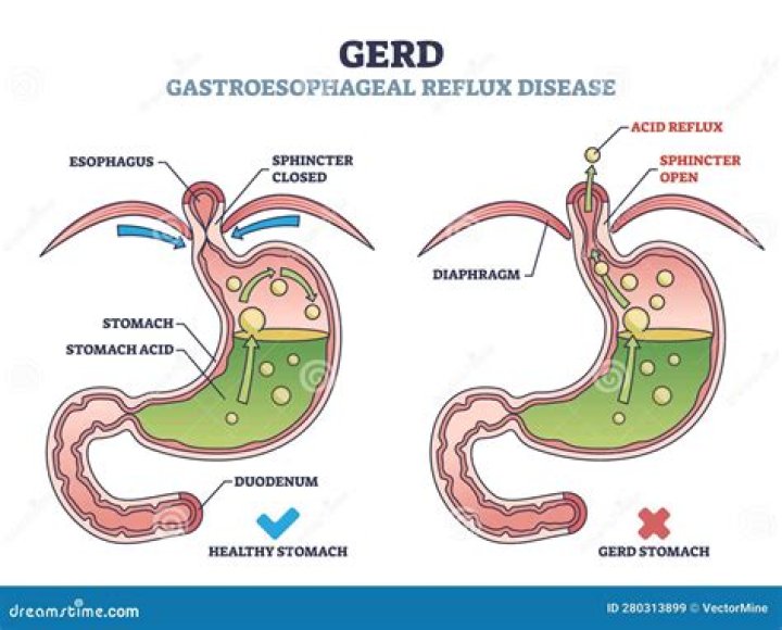 Is GERD the same as silent reflux?