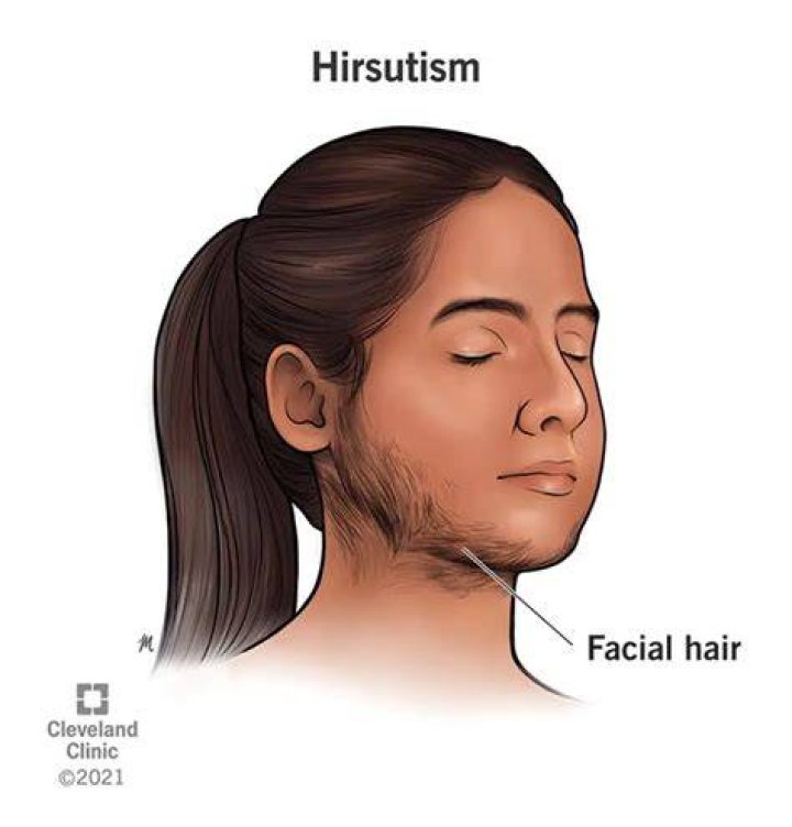 Is hirsutism always PCOS?