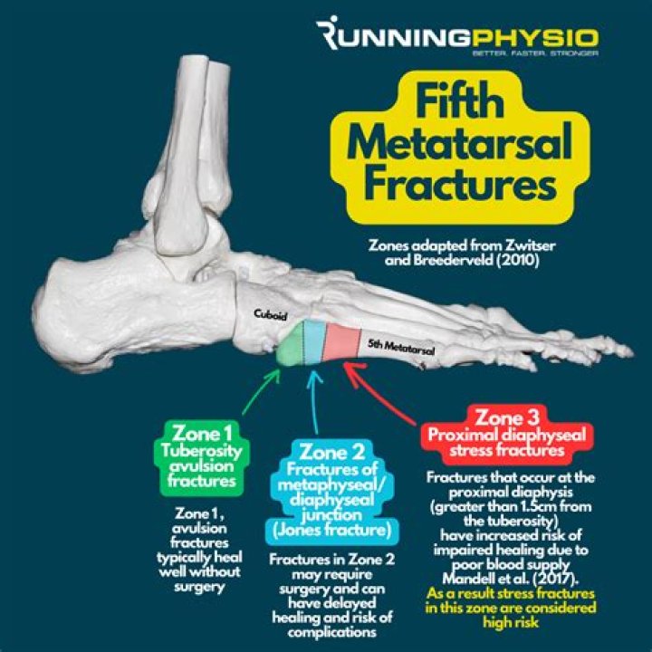 Is it easy to break your 5th metatarsal?
