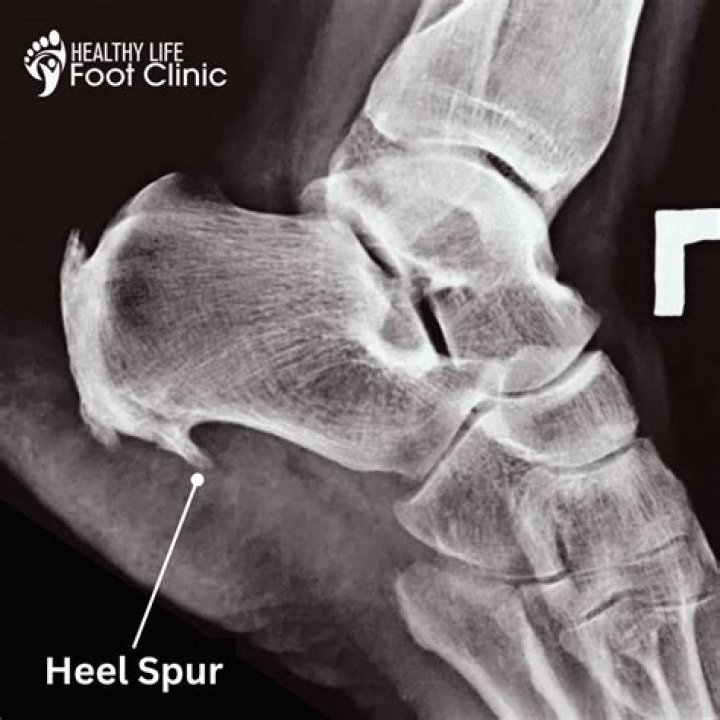 Is it good to rub a heel spur?