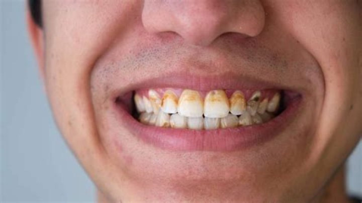 Is it OK to scrape tartar off your teeth?