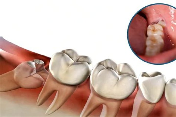 Is it OK to swallow after wisdom teeth removal?