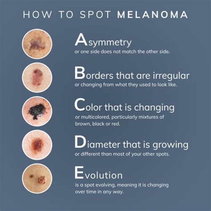 Is melanoma rough or smooth?