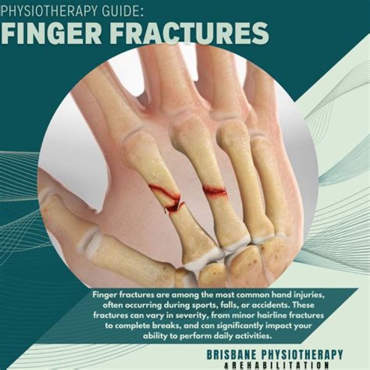 Is my finger broken or dislocated?