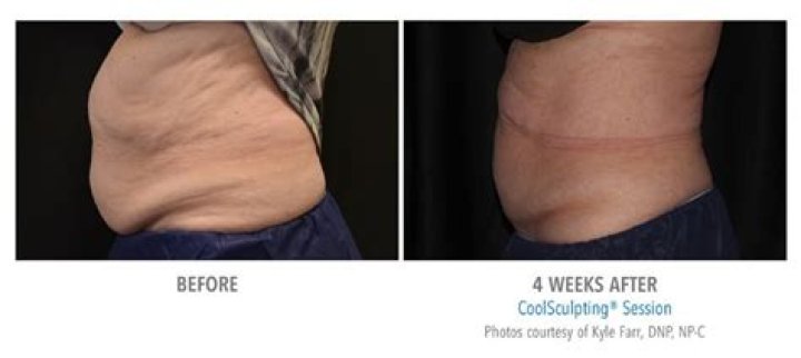 Is one session of CoolSculpting enough?