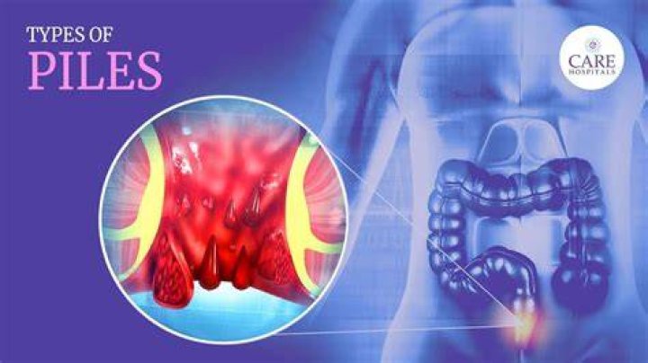 Is piles a lifelong disease?