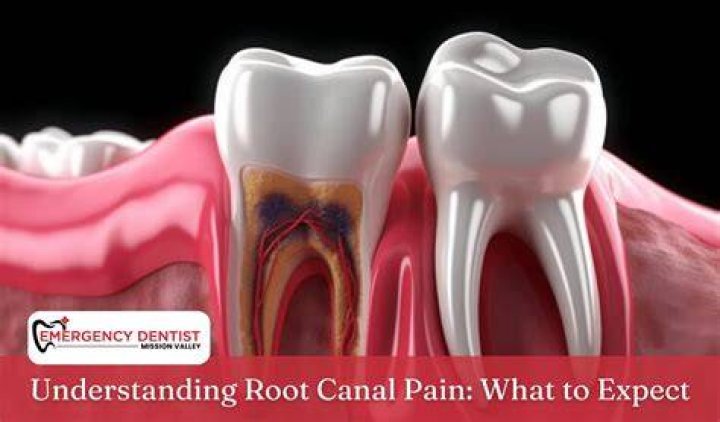 Is second part of root canal painful?