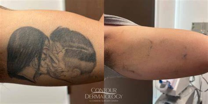 Is there instant tattoo removal?