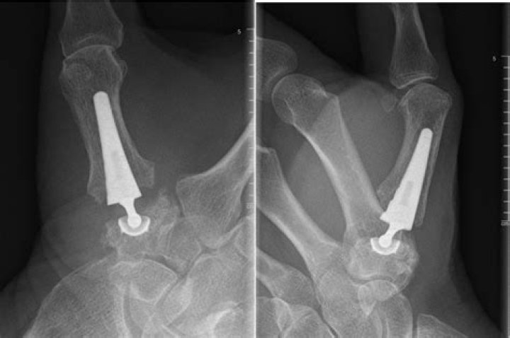 Is thumb joint replacement successful?