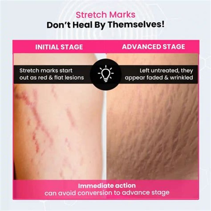 Is vitamin C or E better for stretch marks?
