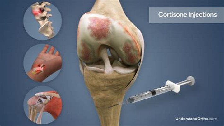 Should I get a cortisone shot in my heel?