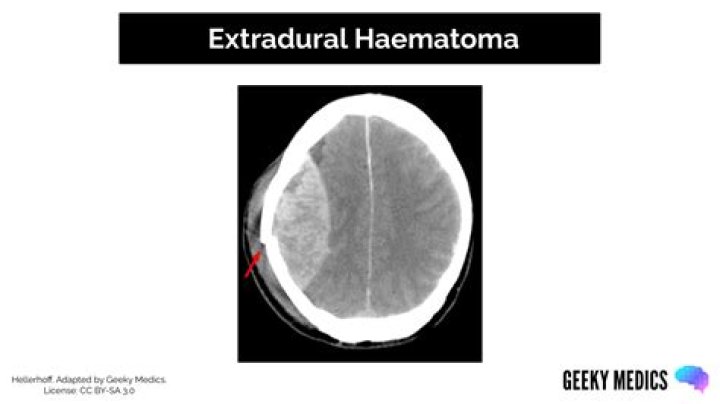 Should I ice or heat a hematoma?