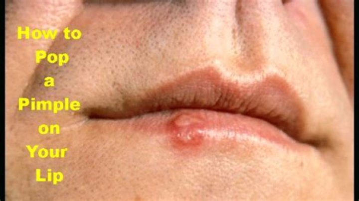 Should I pop a pimple on my lip?