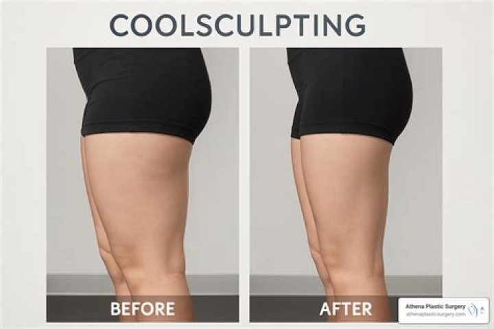 Should you exercise after CoolSculpting?