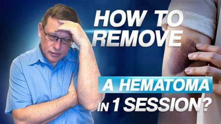 Should you rub a hematoma?