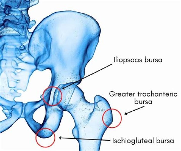 What aggravates iliopsoas bursitis?