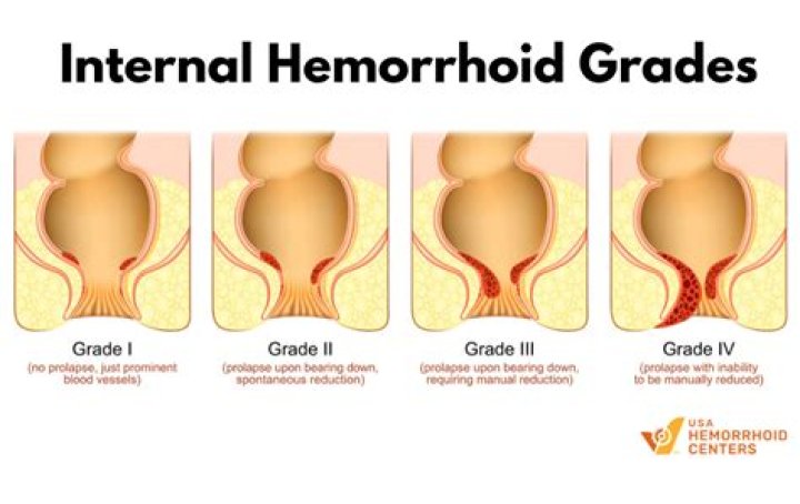 What are Grade 4 hemorrhoids?