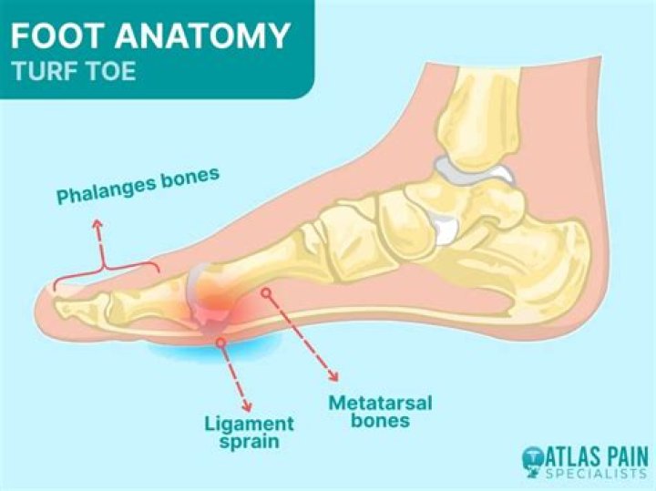 What are the signs and symptoms of turf toe?