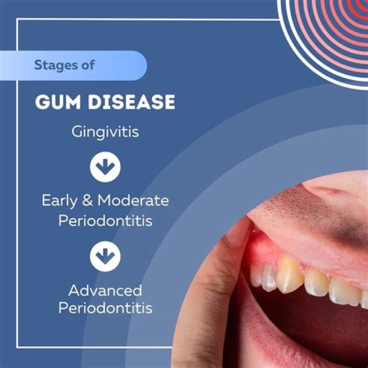 What are the stages of gingivitis?
