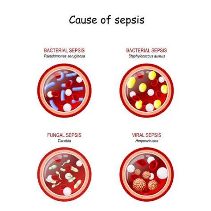 What bacteria causes sepsis?