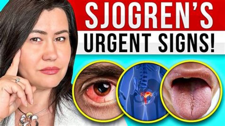 What bloodwork shows Sjogren's syndrome?