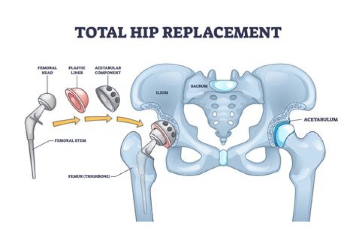 What can you do instead of a hip replacement?